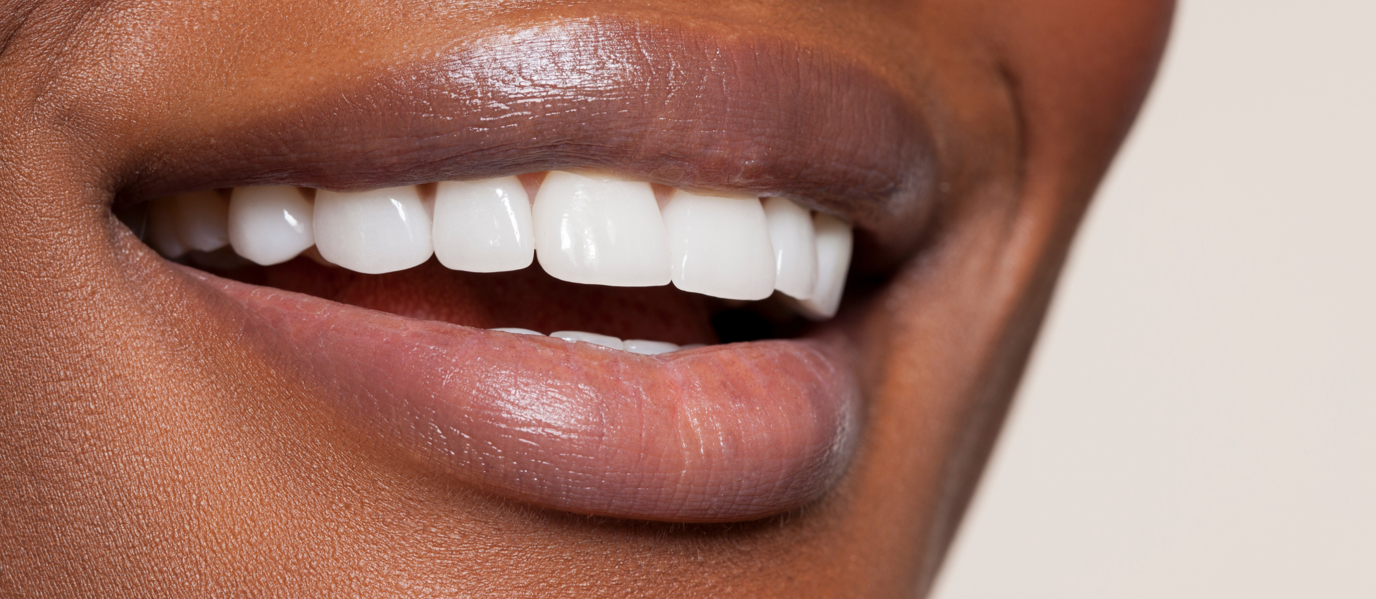 Close up of a flawless smile with veneers in Stuart