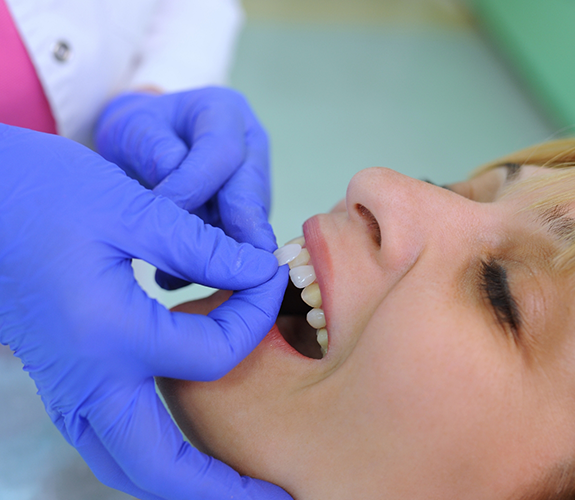 Cosmetic dentist placing a veneer over a tooth