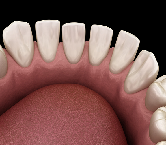 Illustration of an arch of gapped lower teeth